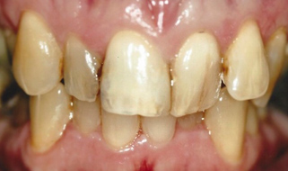 Porcelain Crowns & Veneers