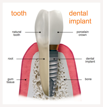 Dental Implants