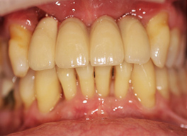 Dental Implants