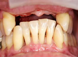 Dental Implants